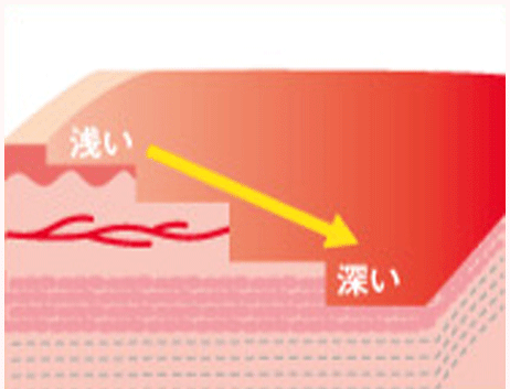 重度のやけどの断面