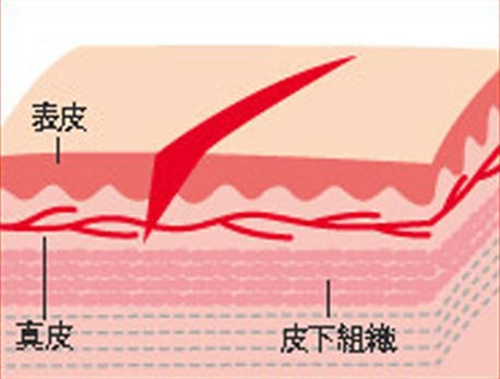 切りキズの断面