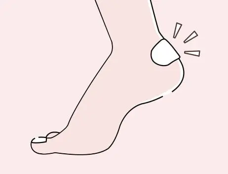 靴ずれ 治りかけの再発予防も肝心