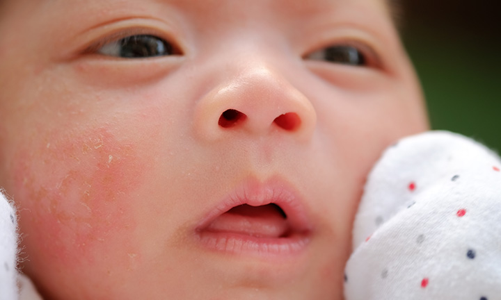 Baby Acne: What Causes It and How Treat It Pampers