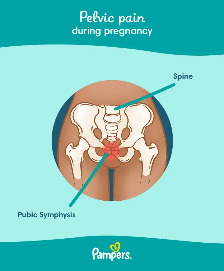 Pubic symphysis dysfunction (SPD) during pregnancy