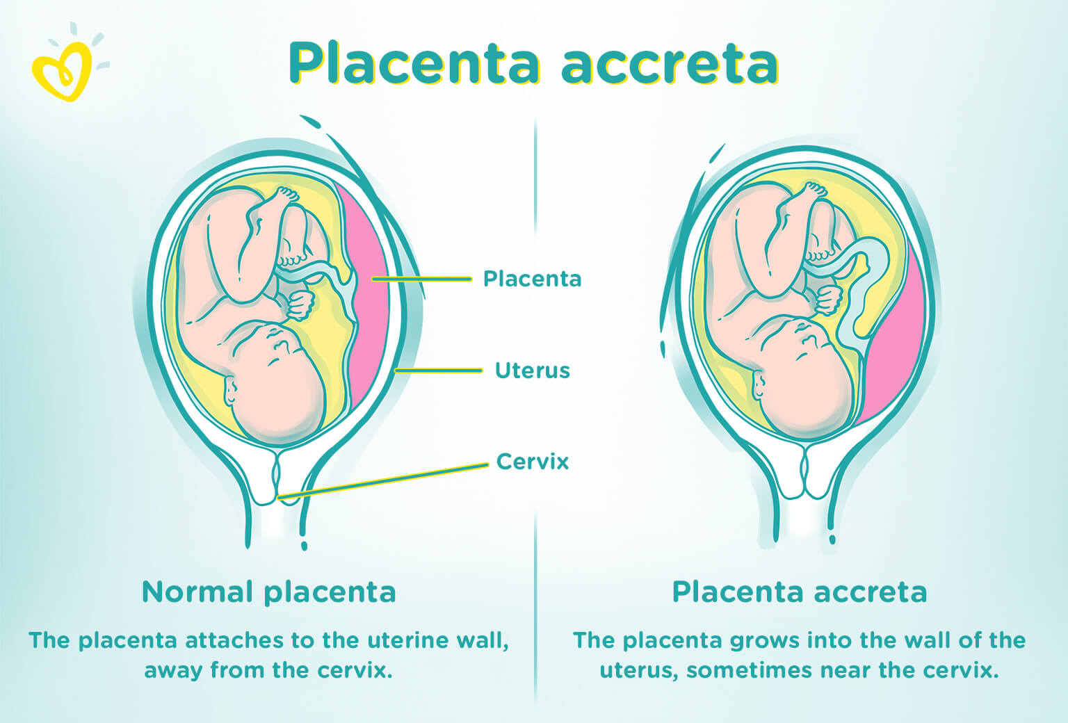 Pregnancy complications placenta accreta symptoms of diabetes horse racing betting sporting life