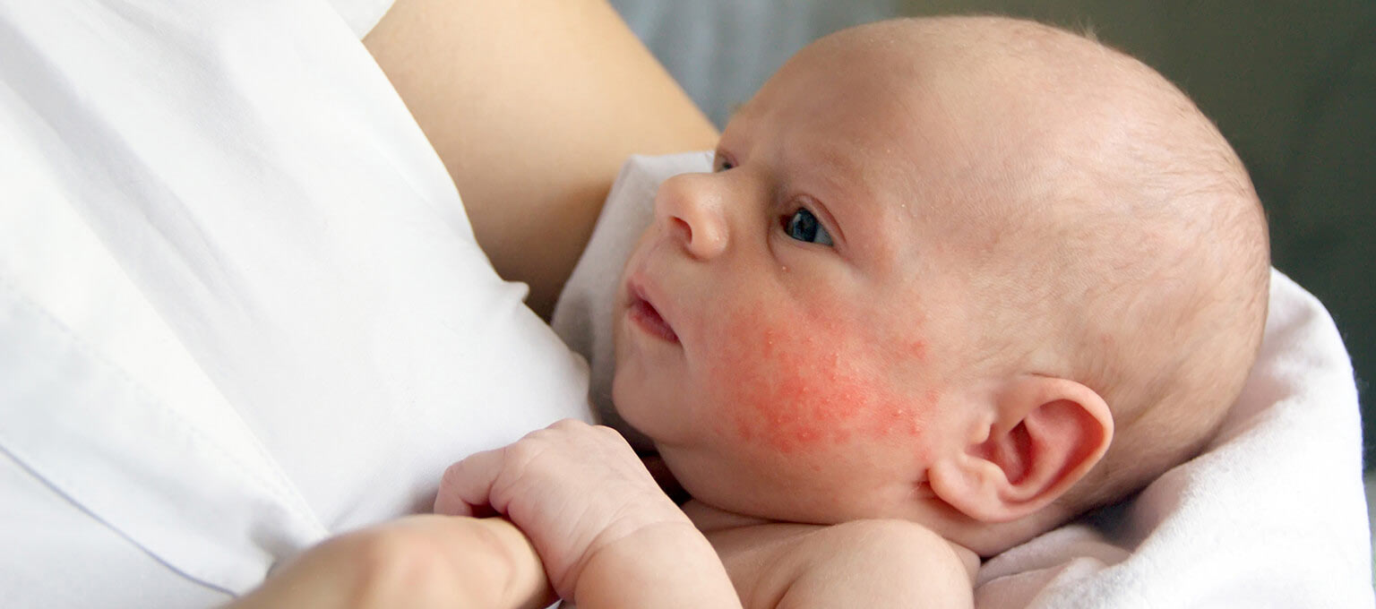 14 Types of Common Baby Rashes