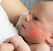  Baby suffering from eczema