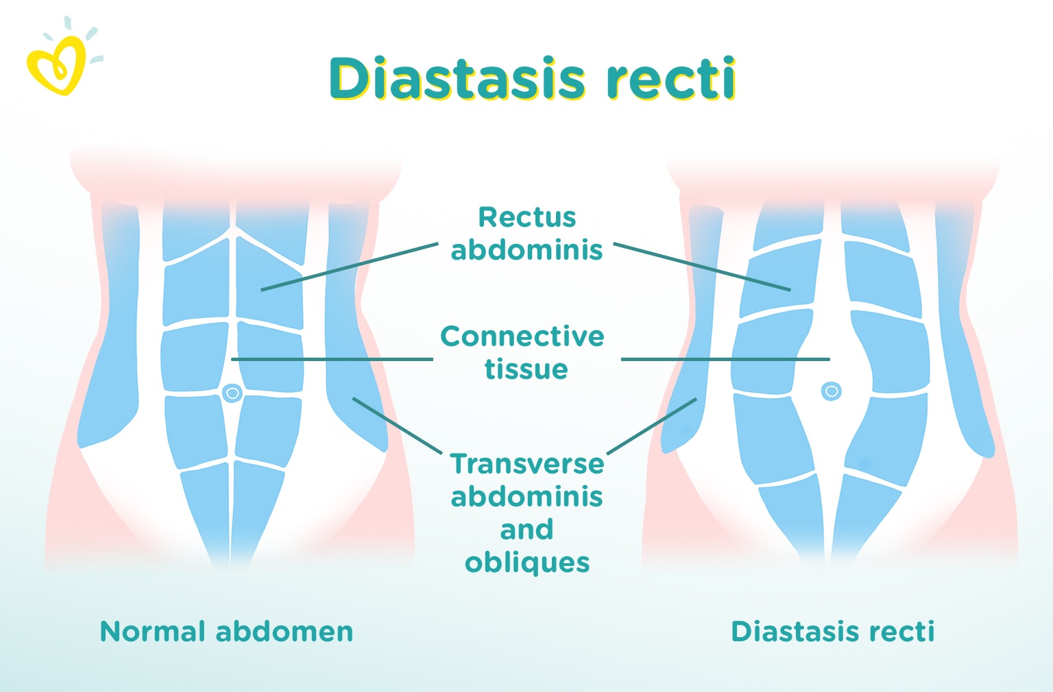 Diastasis recti Hvad er abdominal adskillelse? Pampers St. Charles