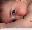 Baby birthmarks