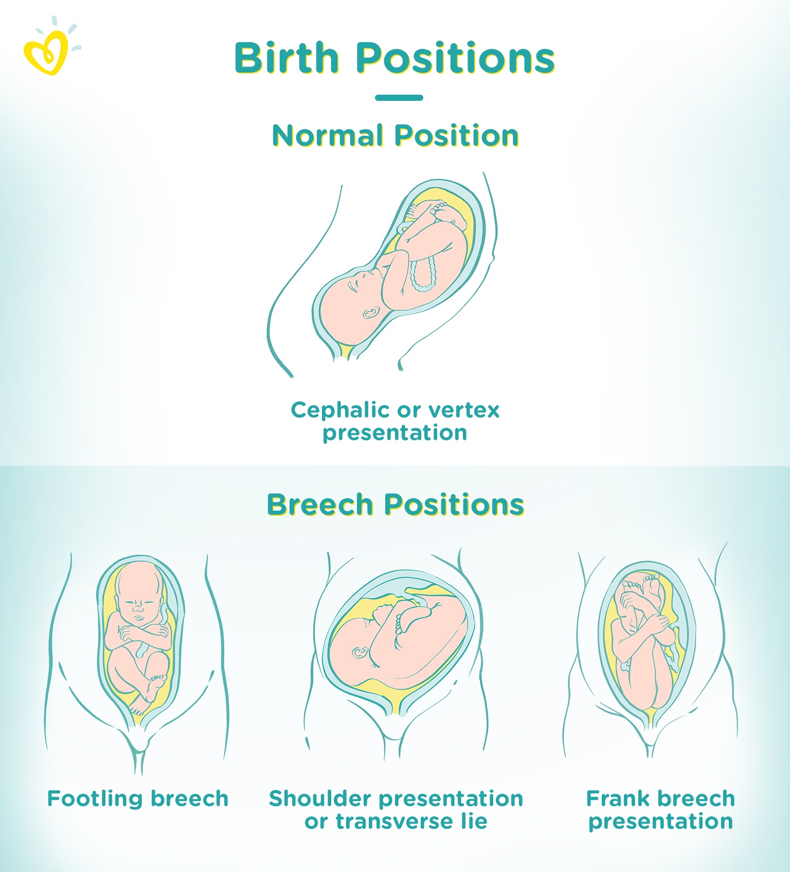 the fetus is in breech presentation