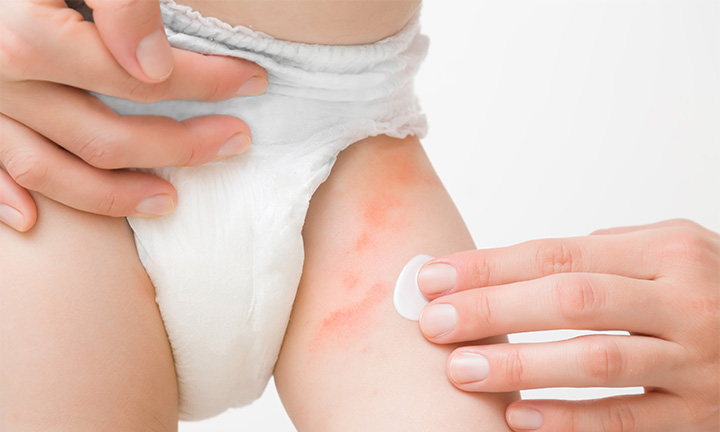 Parenting: My Diaper Rash Tips - What Would V Wear