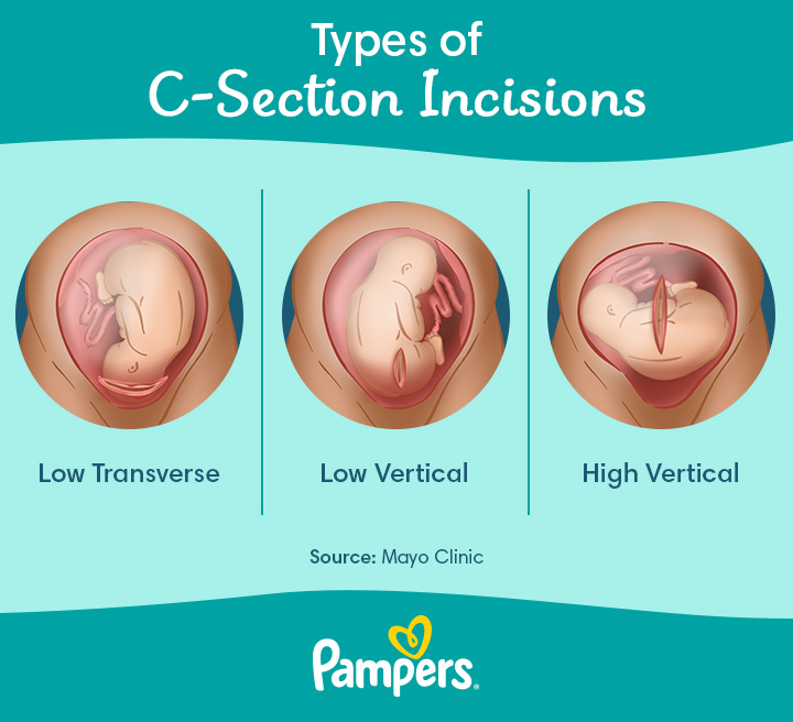 C-section wound infection: Signs and prevention
