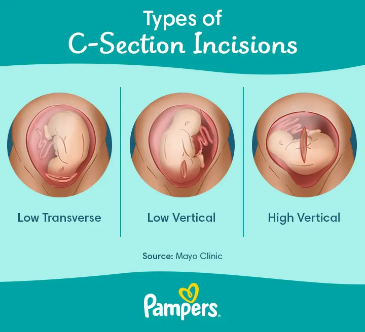 Common Side Effects of Cesarean Delivery Or C-Section