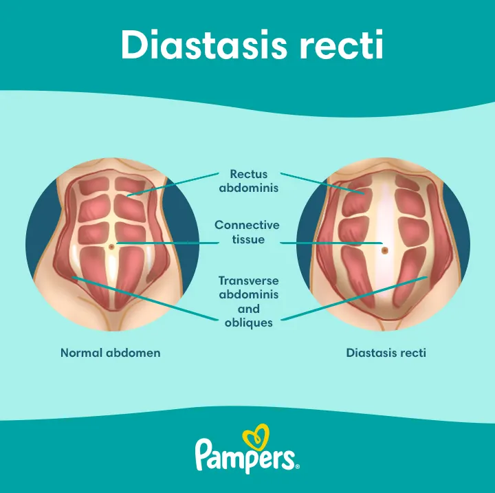 Sleep Positions for Diastasis Recti 