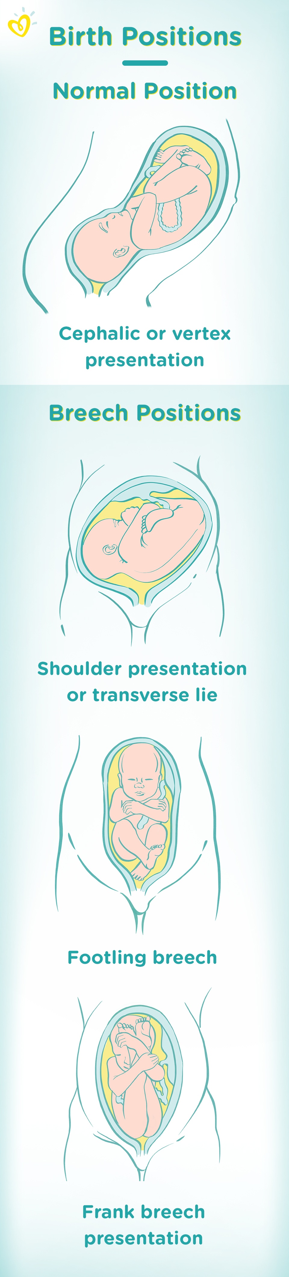 breech presentation in kannada meaning