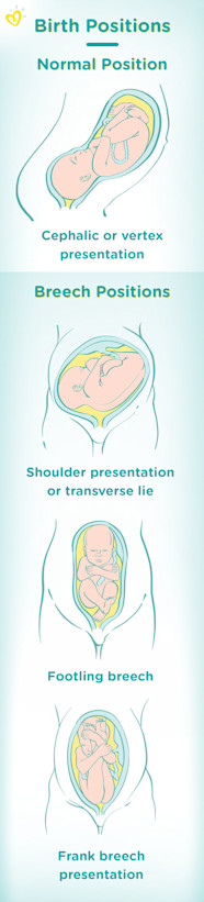 What Is The Meaning Of A Breech Baby At Amie Blom Blog