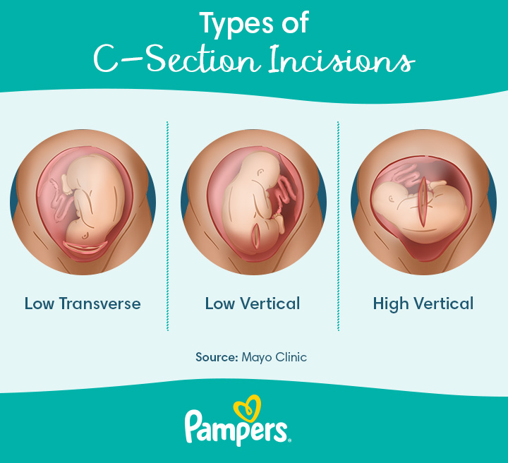 cesarean section anatomy