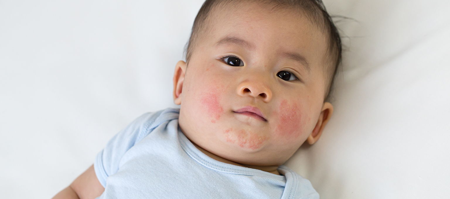 Fifth Disease (Erythema Infectiosum): Symptoms, Causes & Treatment