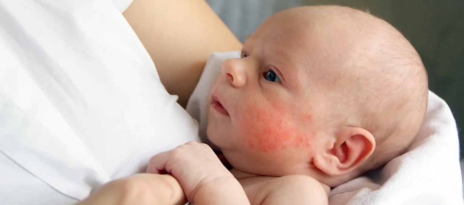 14 Types of Common Baby Rashes | Pampers