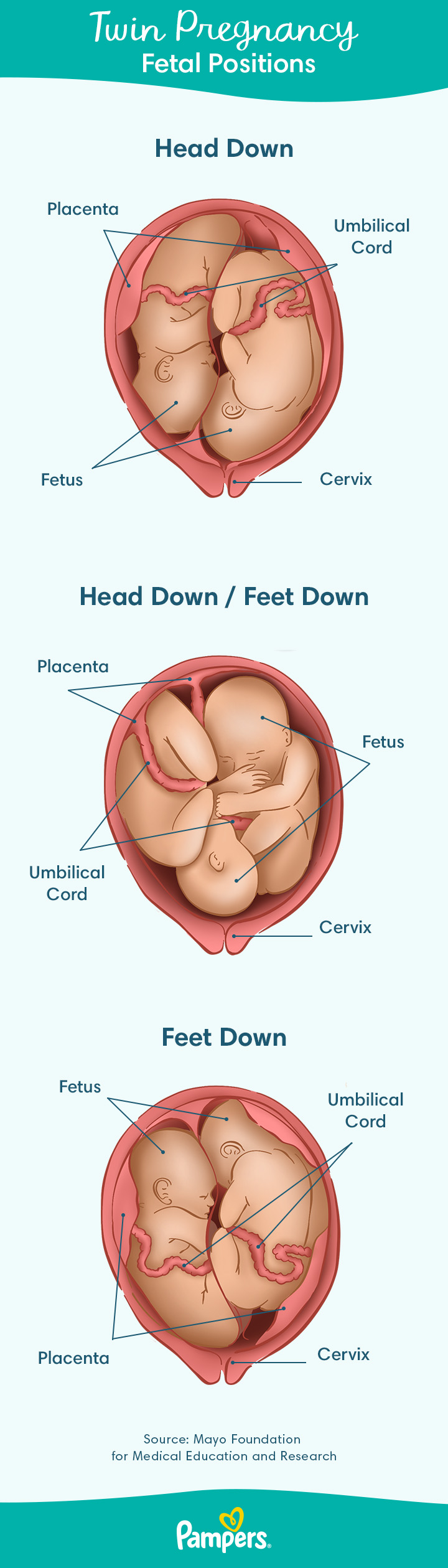 twin presentation in pregnancy