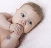 Manchas de nacimiento o hemangiomas en bebés