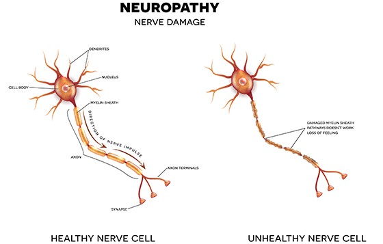 Neuropati Perifer - Definisi, Jenis, dan Pengobatannya