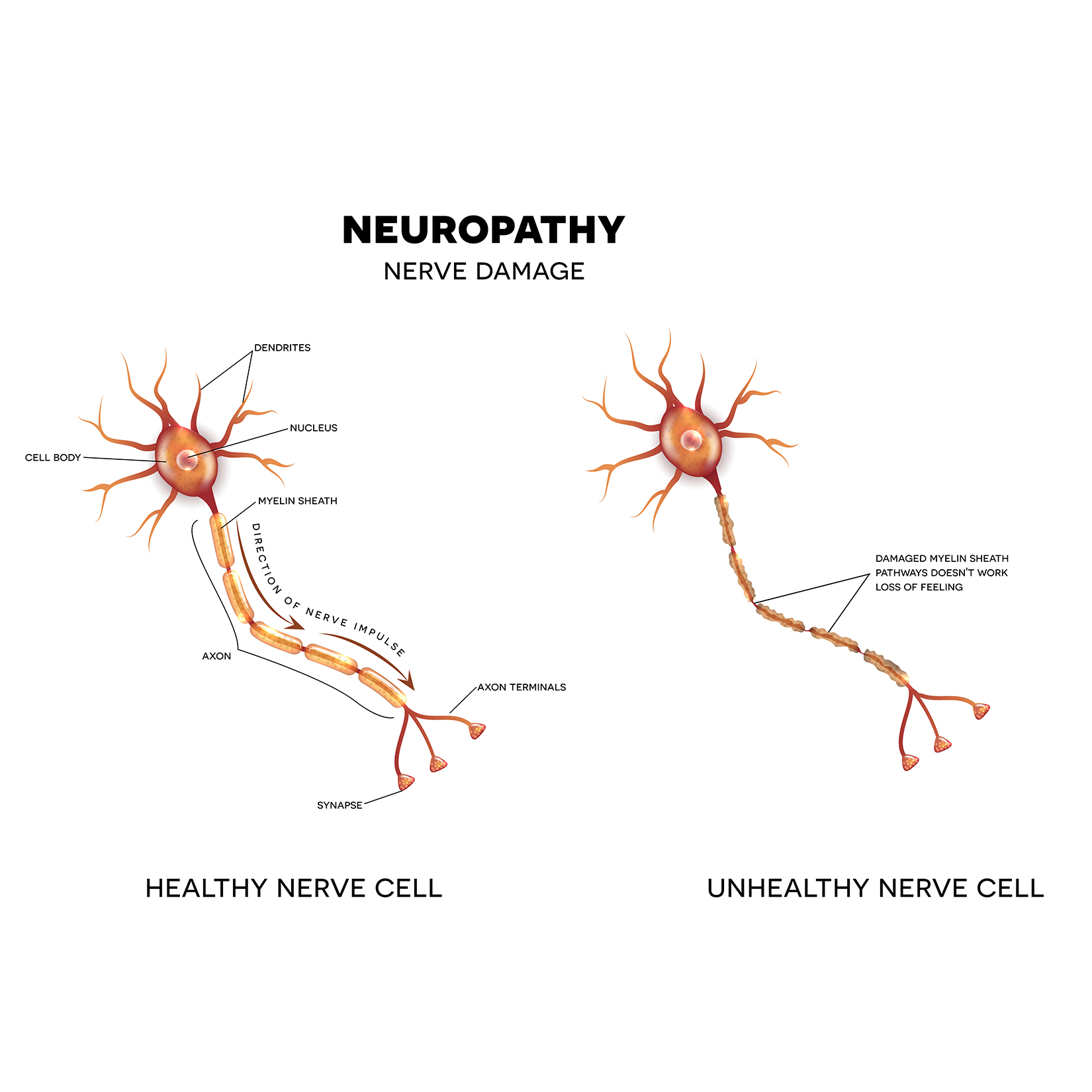 Sekilas Tentang Neuropati Perifer