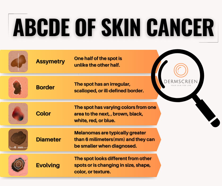 The ABCDEs Revisited: How to Identify Melanoma Warning Signs ⛔