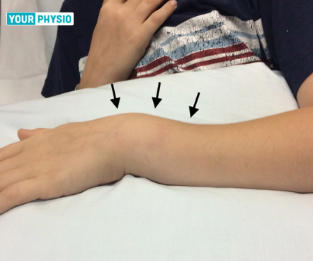 Colles' Wrist Fracture: Causes, Treatment, and Fracture