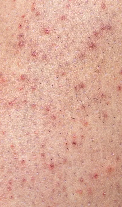 A close-up of razor rashes on the legs.