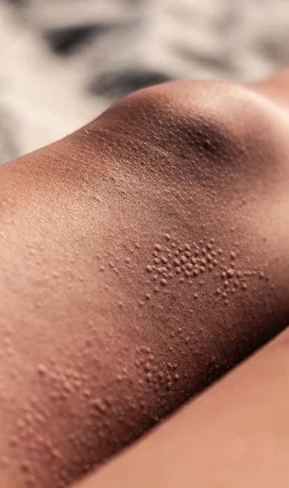 A close-up of razor rashes on the legs.
