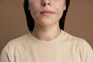 Everything About Acne: What You Need to Know