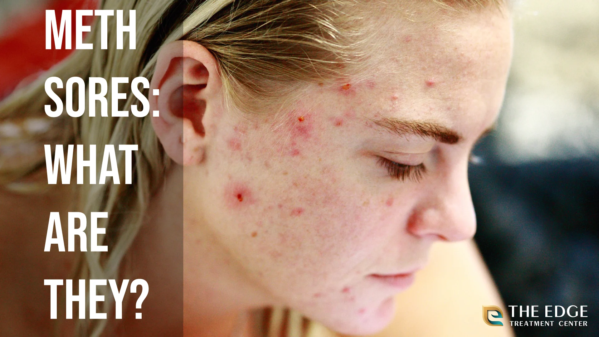 Meth Sores: What are Meth Sores? Meth Sores: What are Meth Sores?