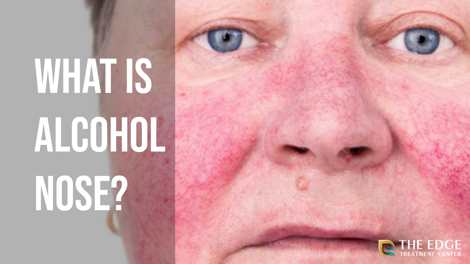 What Is Alcoholic Nose?