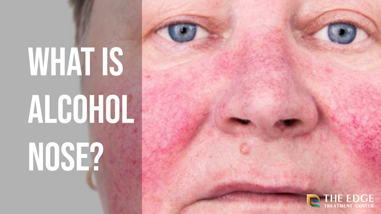 Alcoholic Nose Meaning | What is Alcoholic Nose or Rhinophyma – IJCDF