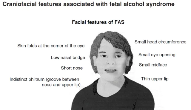 Symptoms of Fetal Alcohol Syndrome