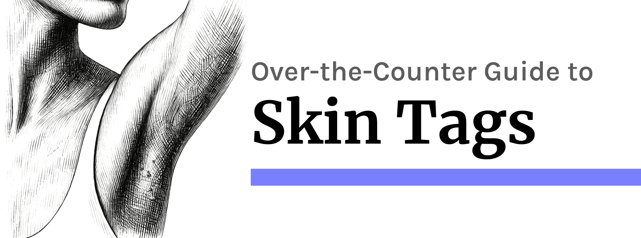 Skin Tags: At-Home Removal and Warnings