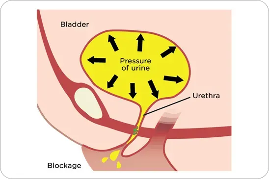 Overflow incontinence