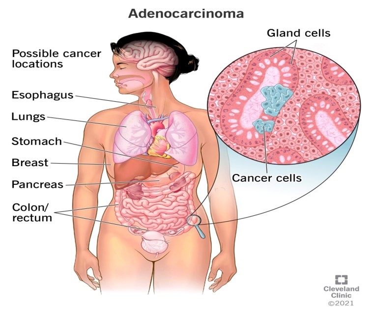 Types of cancer