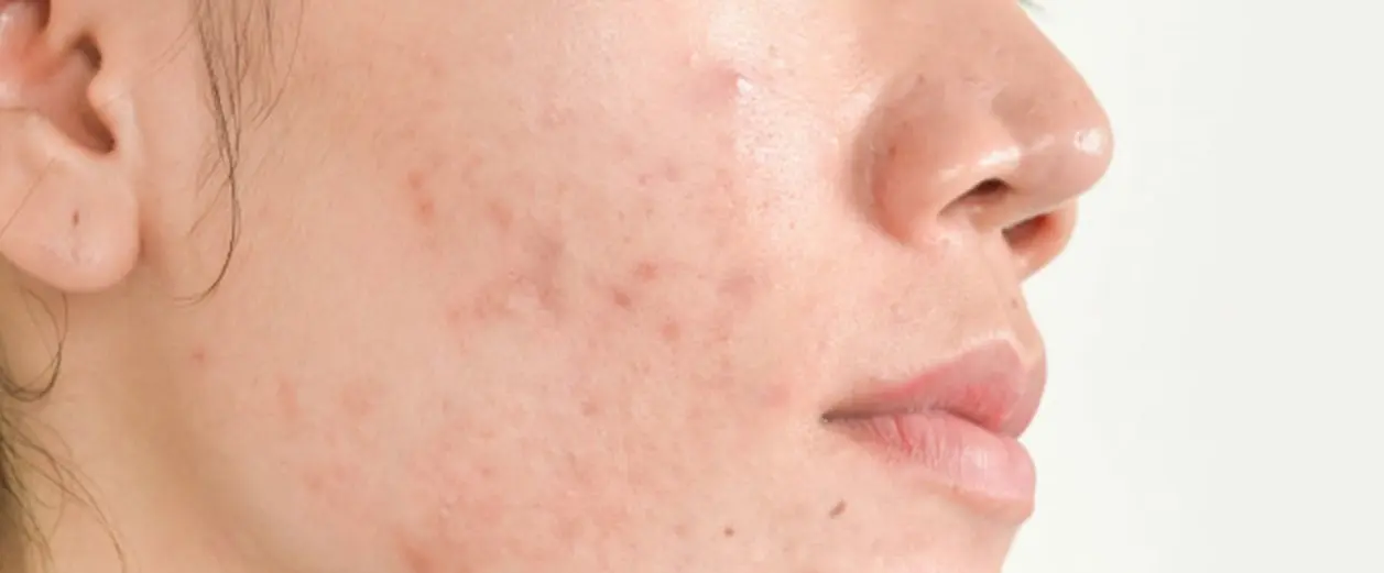 what-is-acne-vulgaris-why-does-it-sound-so-weird--en-in