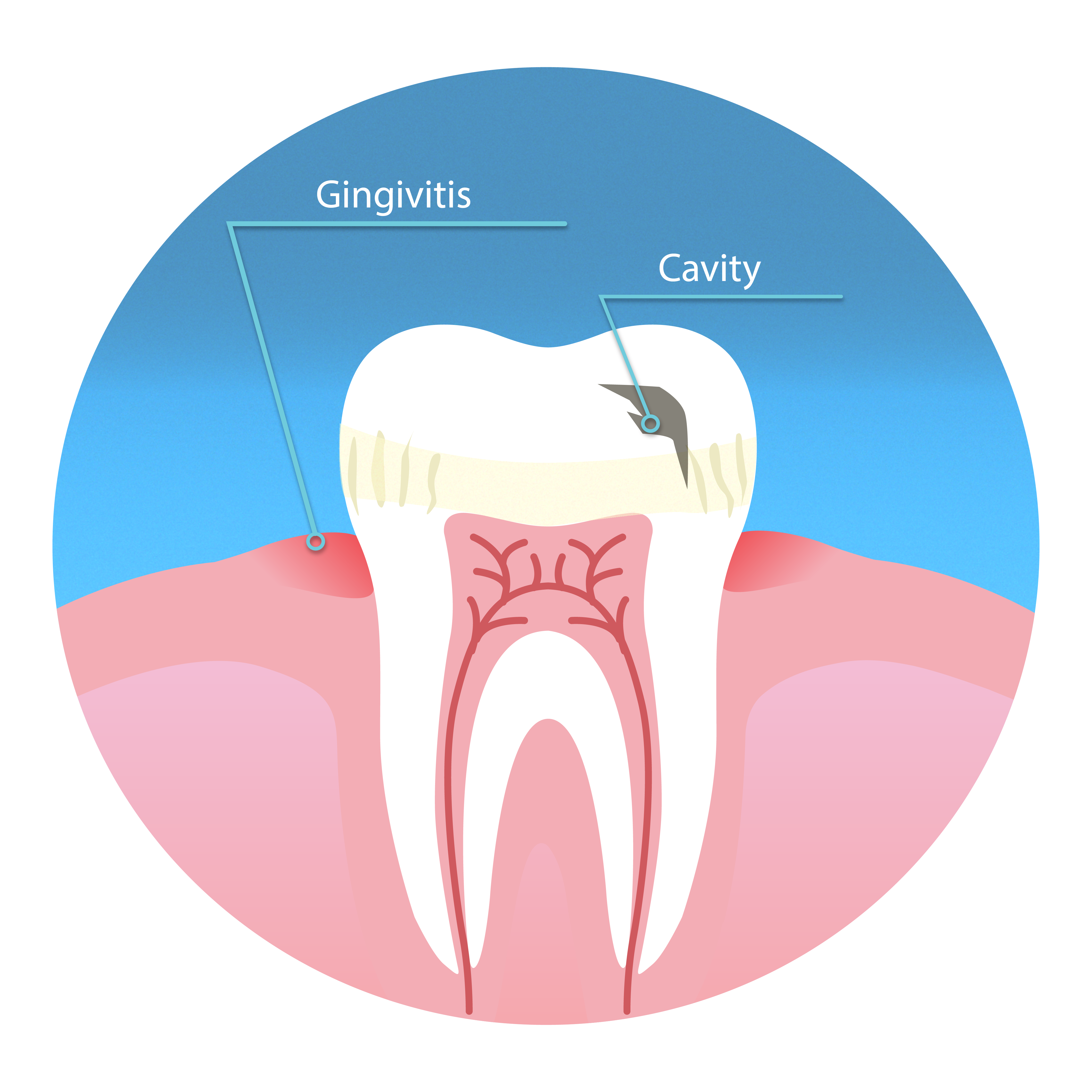 Illustration of a tooth showing gingivitis developing in the gums and a cavity spot on the tooth 