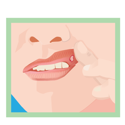 Illustration of the bottom half of a person's face, including their nose and mouth. The top lip is being propped open by the person's index finger to show a canker sore on the inside of the lip. The person's top teeth are also visible. 