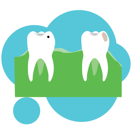 Illustration of two teeth next to each other. One tooth has a small black dot and another has a gray spot - these are to indicate cavities in the teeth. 