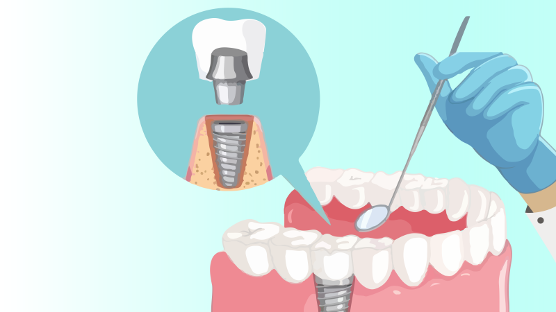 Dental implants are a popular option for replacing missing teeth. Find out what implants are, how they can be used and when another option might be a better choice. 