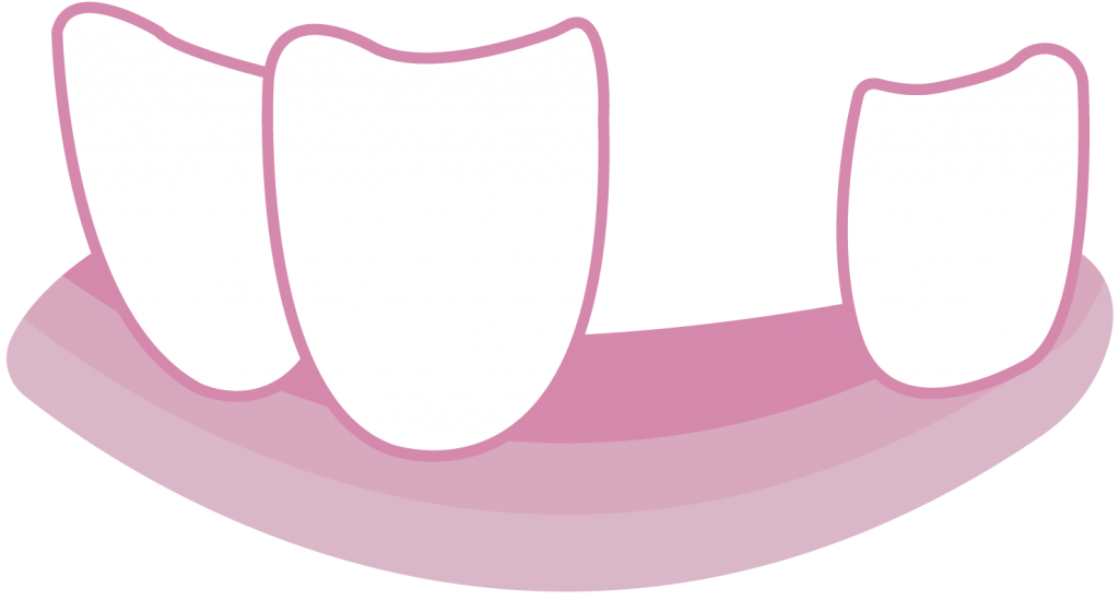 Graphic of bottom jaw with missing tooth
