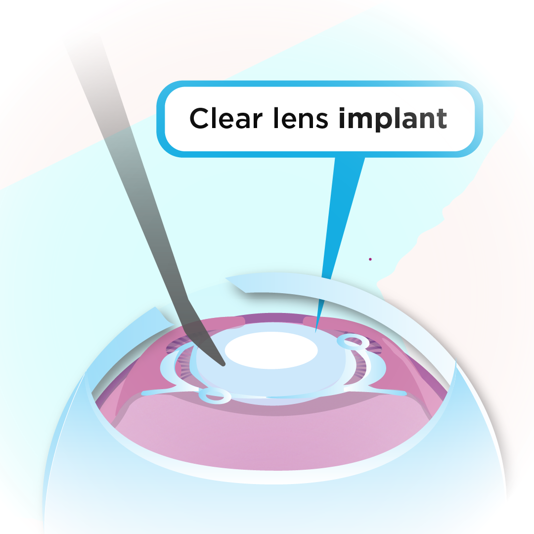 Illustration of a lens of the eye beging removed because of a cataract and replaced with a clear lens to improve vision