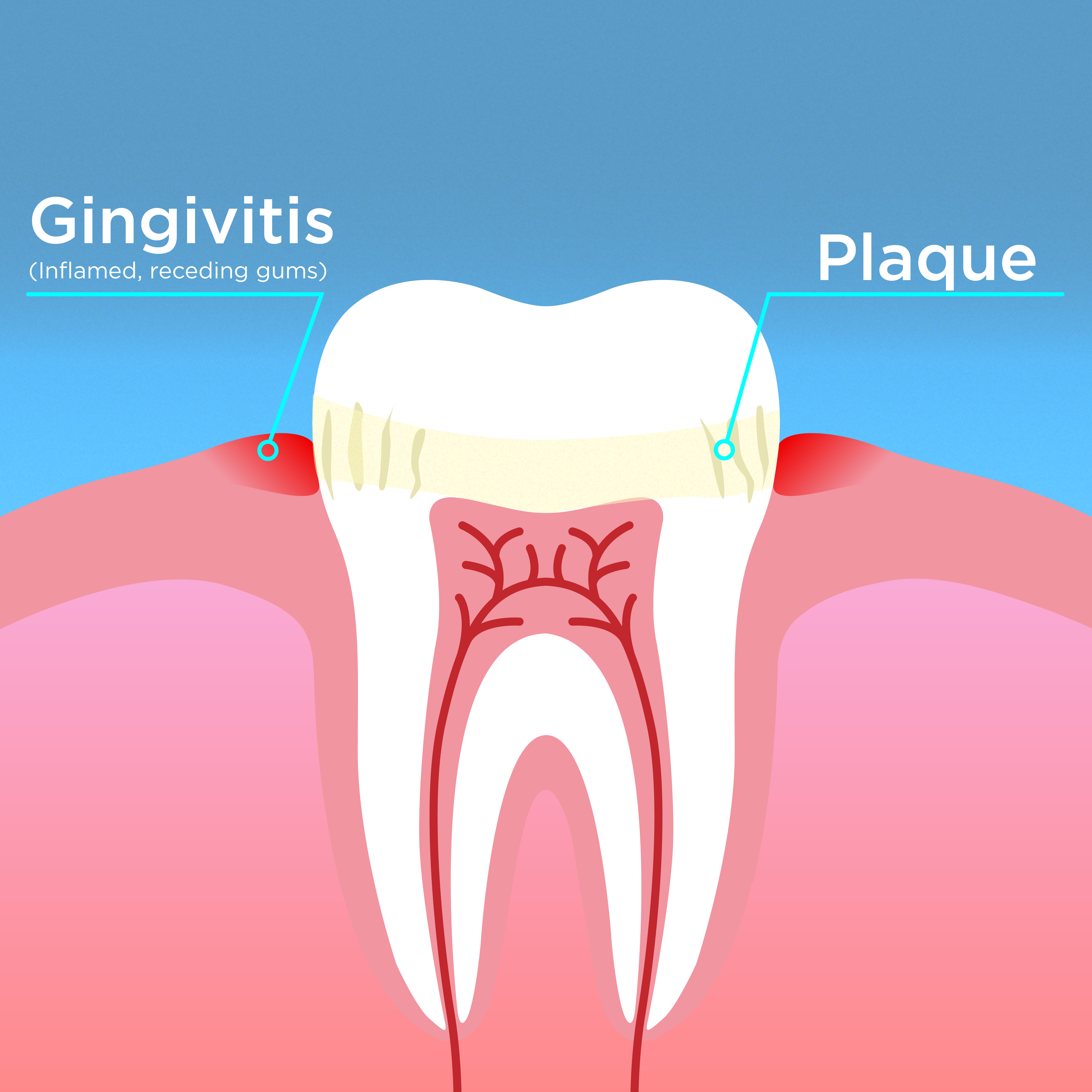 Diagram of tooth set in gums showing where to look for the appearance of gingivitis and plaque. 