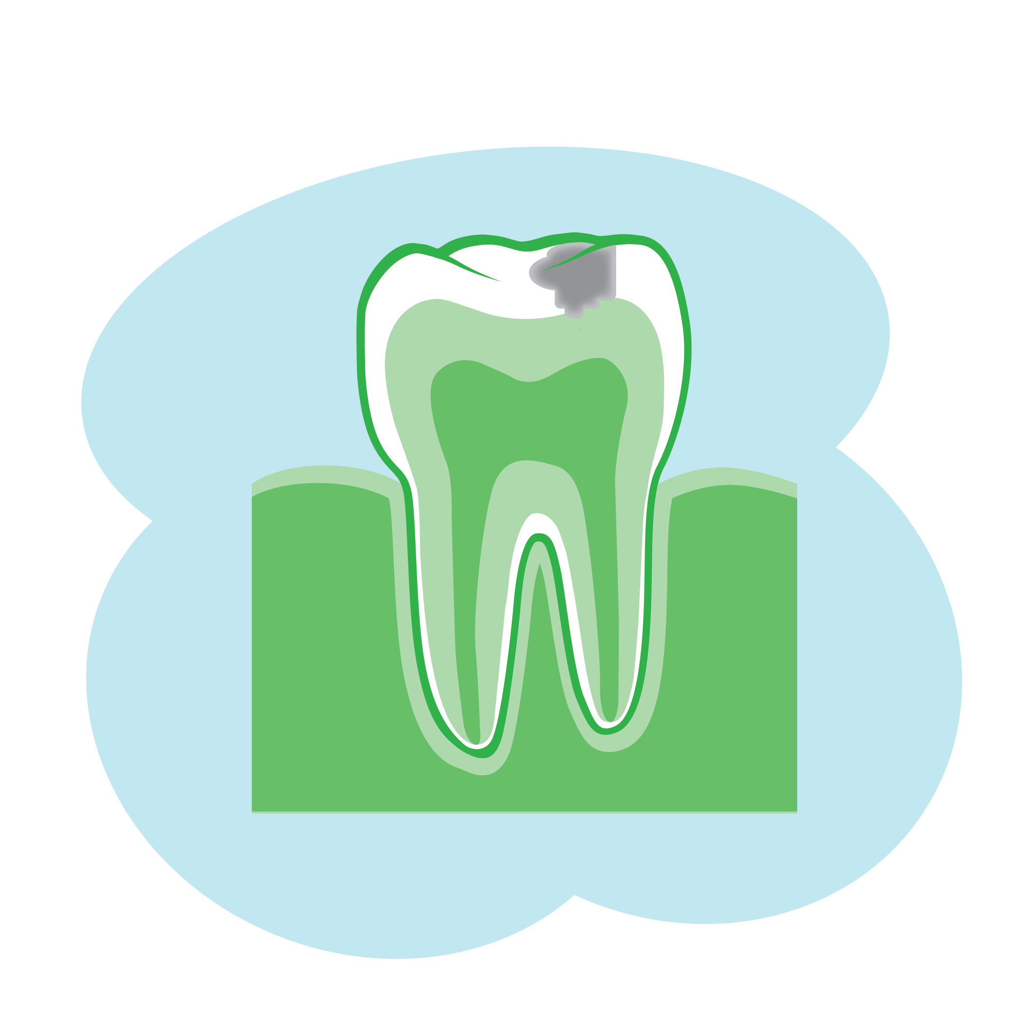 illustration showing enamel erosion (cavity) developing on tooth