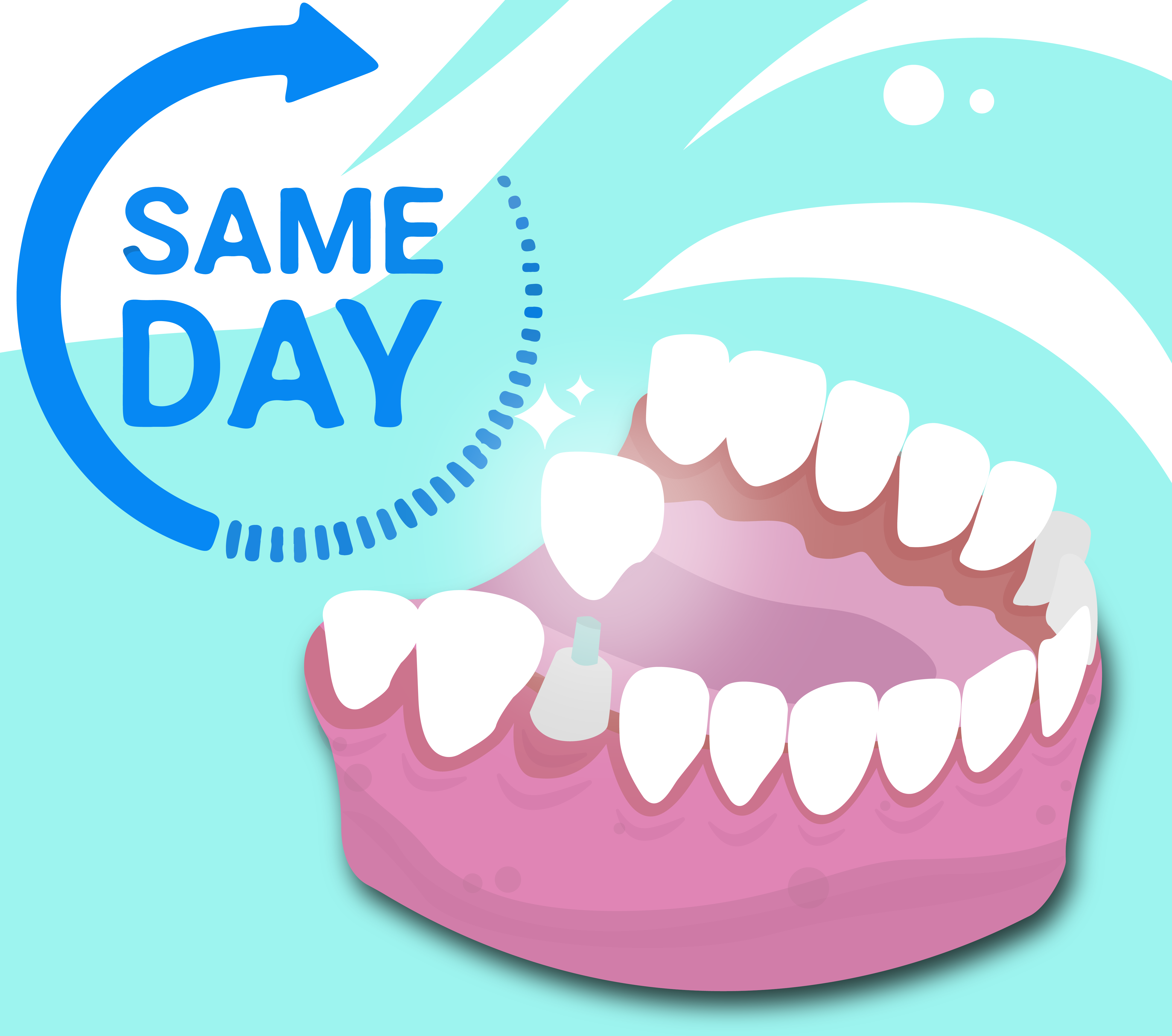 Illustration of a same-day dental crown about to be placed on a shaped tooth, with text reading 'Same Day' to highlight the fast and efficient process of crown placement.