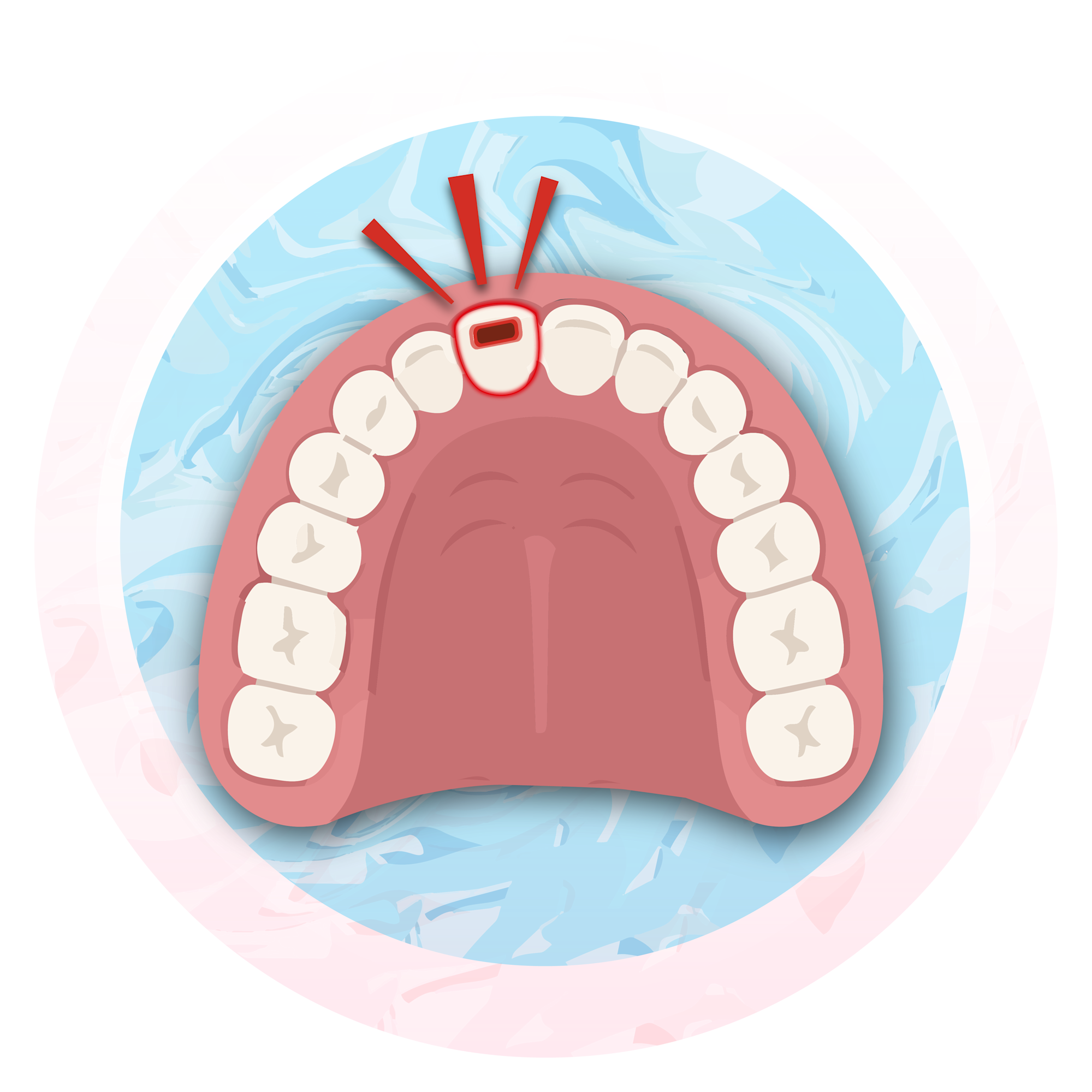 Picture of a chip in the furthest back molar where the root of the tooth is exposed 