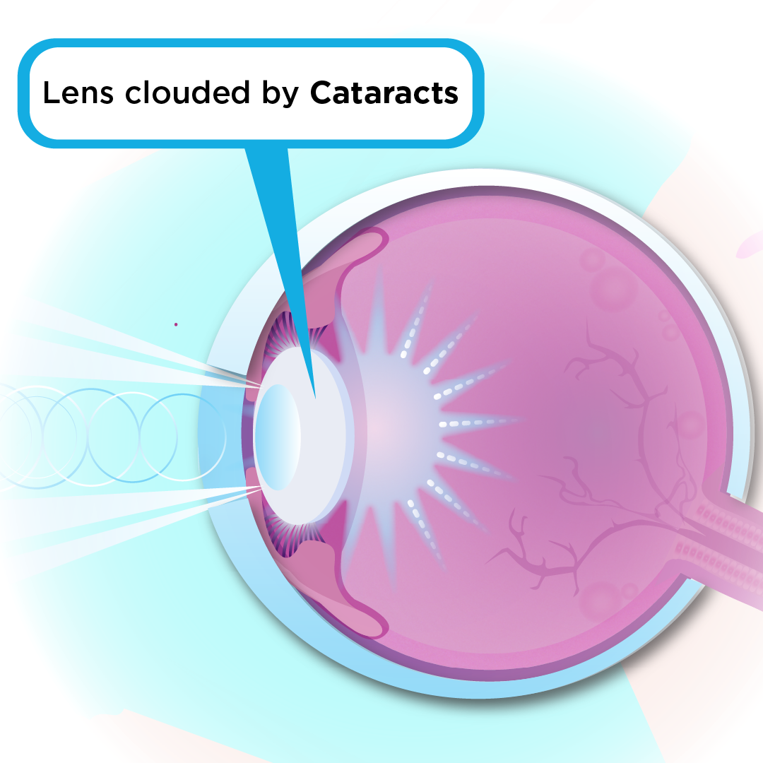 Image showing an eye with a clouded lens from a cataract 
