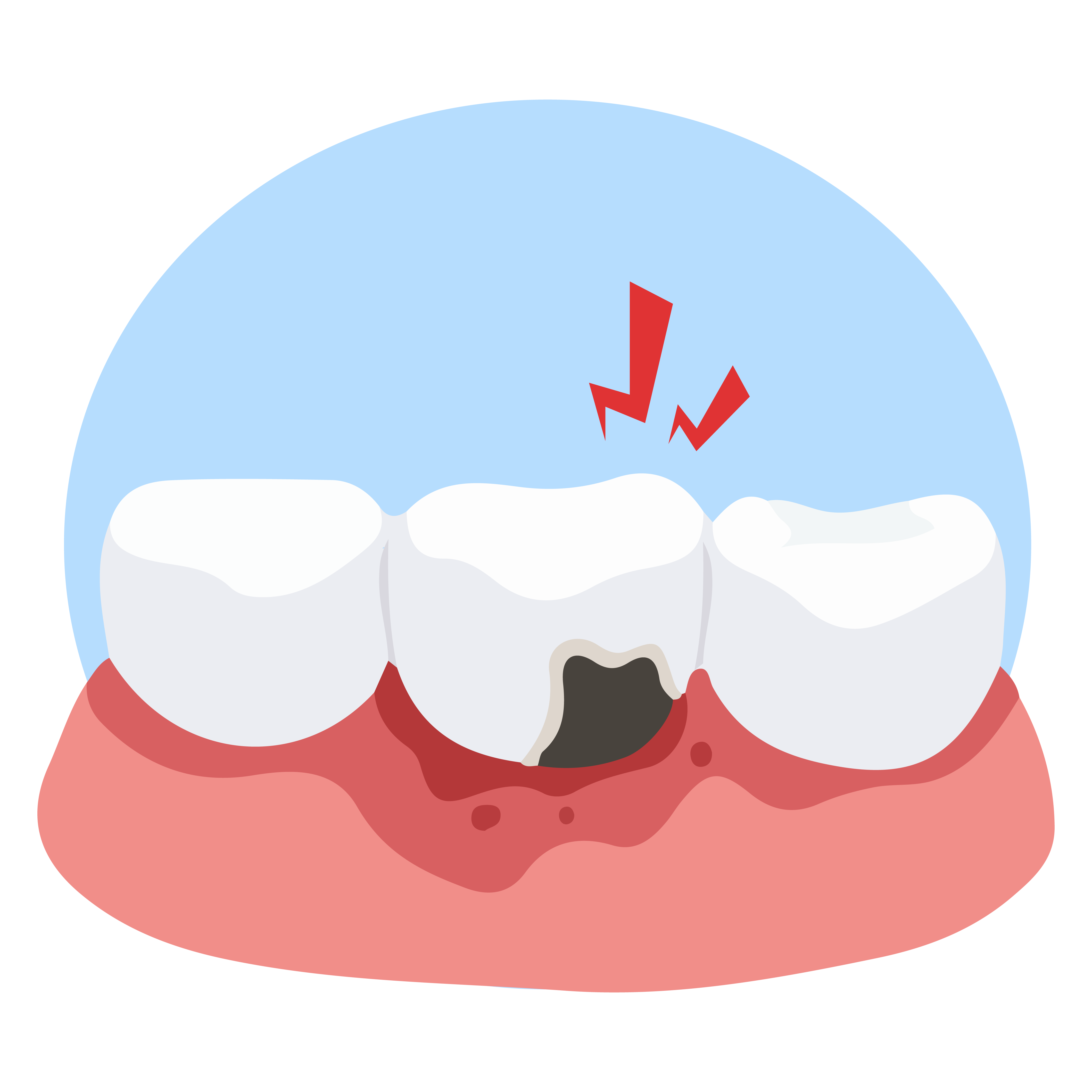 Illustration of 3 teeth and gums with a black spot at the base of one tooth and red symbols to express pain in order to indicate a cavity to be treated using dental anesthesia. 