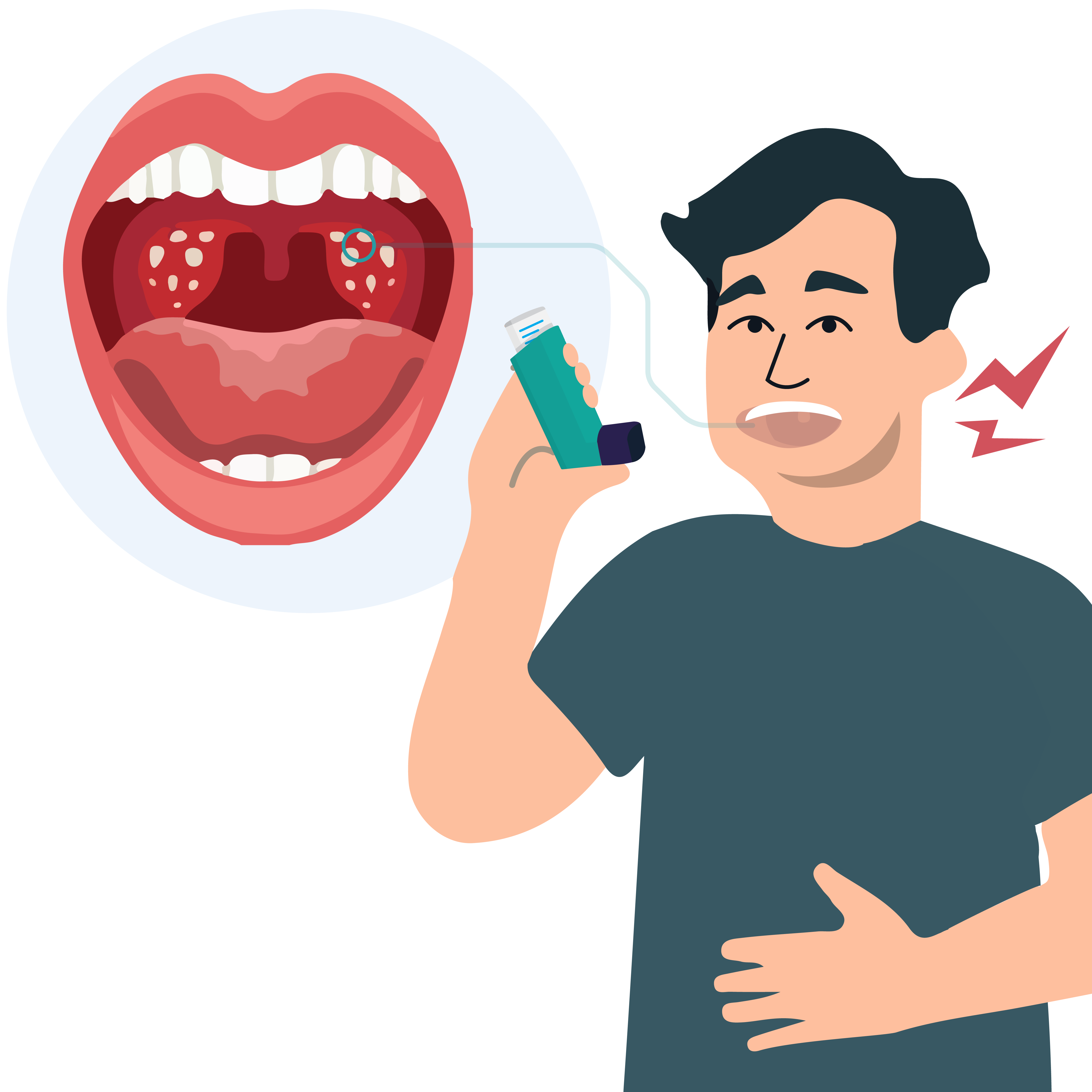 Man holds inhaler next to a diagram of a mouth with white dots on the tonsils indicating thrush